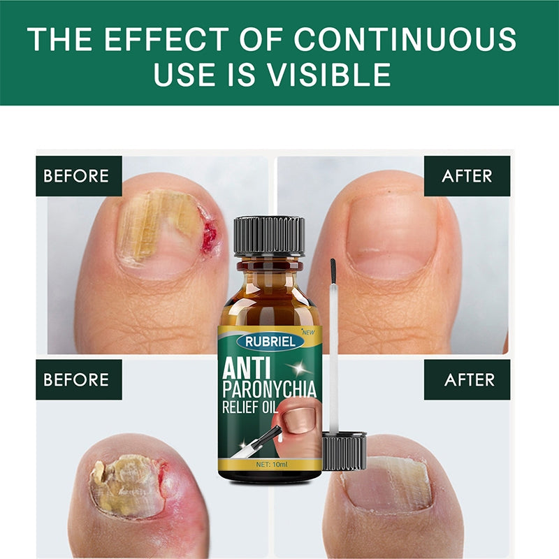 Anti Paronychia Relief Oil ( BUY 1 GET 1 FREE )