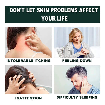 Japan Anti - Fungal Ointment Eczema Cream ( BUY 1 GET 1 FREE )