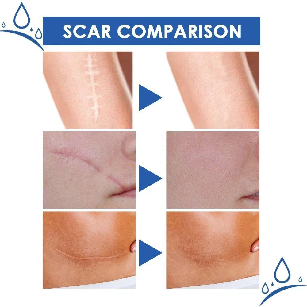 JAYSUING™ Scar Removal Cream ( BUY 1 GET 1 FREE )