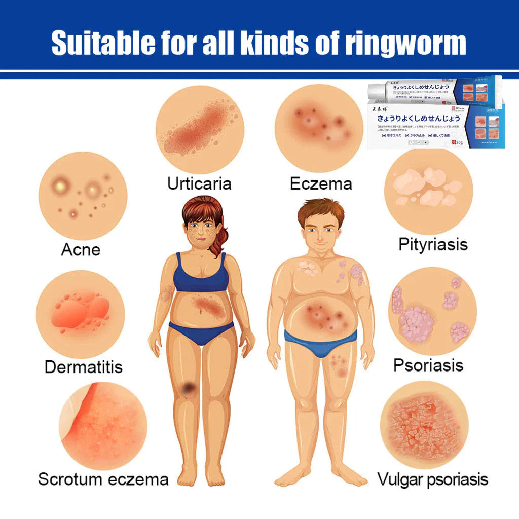 Japan Anti - Fungal Ointment Eczema Cream ( BUY 1 GET 1 FREE )