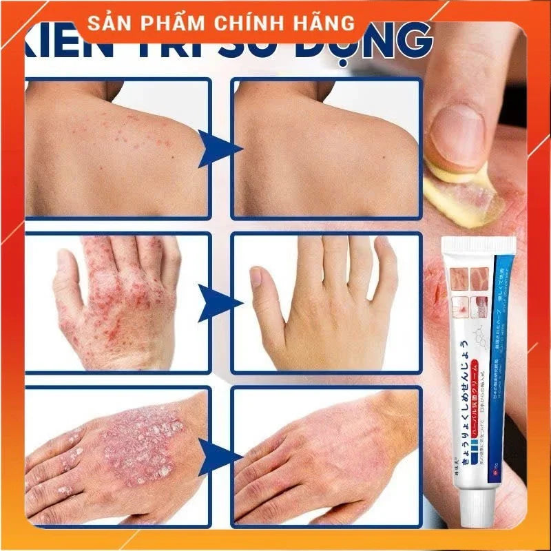 Japan Anti - Fungal Ointment Eczema Cream ( BUY 1 GET 1 FREE )